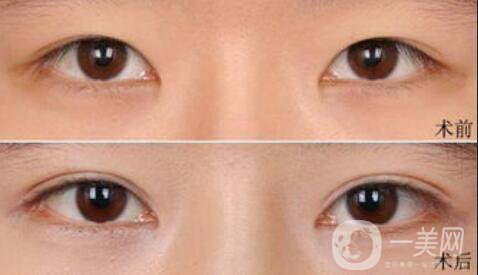 雙眼皮術(shù)后一個月能恢復(fù)自然嗎