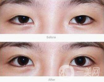 雙眼皮術(shù)后一個月能恢復(fù)自然嗎