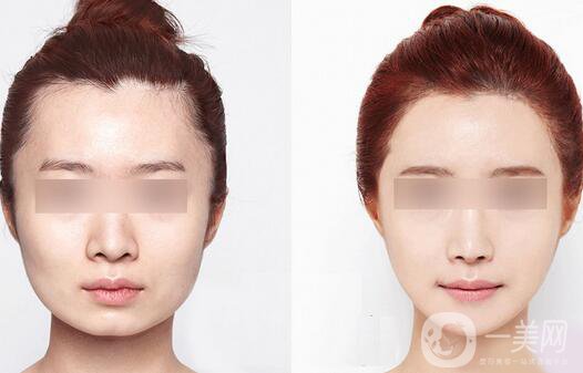 激光溶脂瘦臉注意事項有哪些