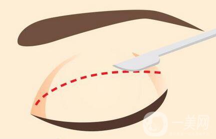 做全切雙眼皮手術(shù)之前有哪些術(shù)前準(zhǔn)備？