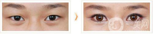 做全切雙眼皮手術(shù)之前有哪些術(shù)前準(zhǔn)備？