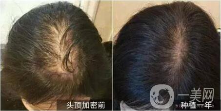 fue植發(fā)和fun植發(fā)區(qū)別有哪些 詳細(xì)介紹一覽