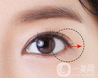 開外眼角風險大嗎？