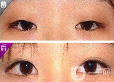 開外眼角風險大嗎？