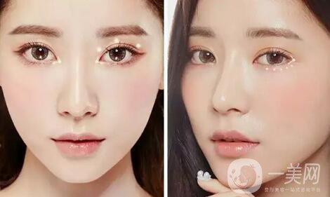 做韓式*雙眼皮術(shù)優(yōu)點(diǎn)有哪些