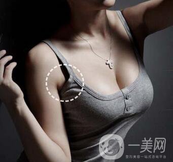 副乳切除術創(chuàng)口多大？