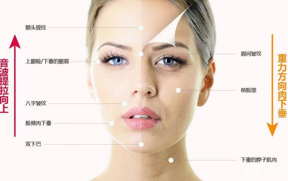 小切口面部提升,手術(shù)過(guò)程,注意事項(xiàng)