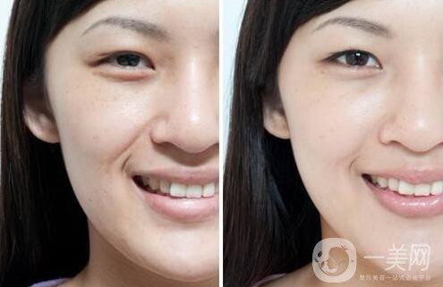 小切口面部提升,手術(shù)過(guò)程,注意事項(xiàng)