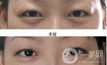 上眼瞼去脂,術后護理