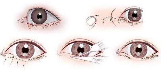 開內(nèi)眼角要多久恢復(fù) 恢復(fù)期長(zhǎng)短和哪些因素有關(guān)