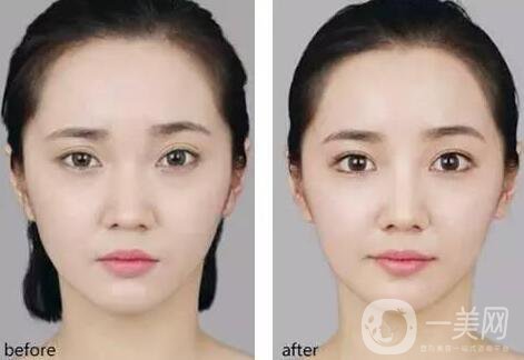 開內(nèi)眼角要多久恢復(fù) 恢復(fù)期長(zhǎng)短和哪些因素有關(guān)