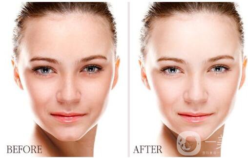 像束激光美白嫩膚*果怎么樣呢