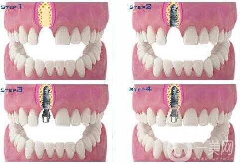 種植牙可以用多久 維持時間解析