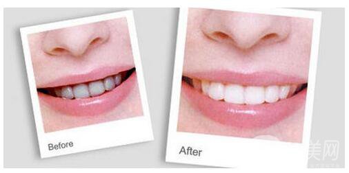 上海做*潔牙價(jià)格多少錢