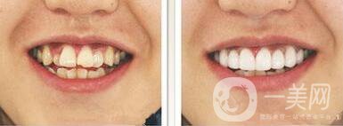 成都種植牙信息介紹？種植牙醫(yī)院信息介紹？