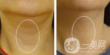 怎么消除頸紋？去頸紋的方法有哪些？