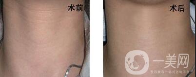 怎么消除頸紋？去頸紋的方法有哪些？