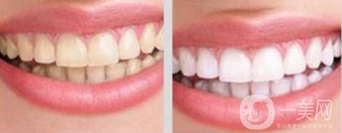 成都做*潔牙大概多少錢