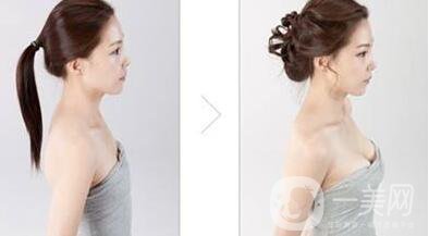 妙桃隆胸,多少錢(qián)