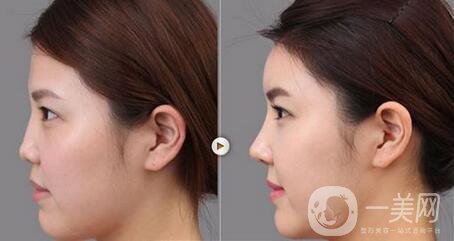 膨體隆鼻缺點主要有哪些？危害大嗎？