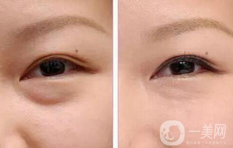 超聲波去眼袋好嗎，有哪些優(yōu)點(diǎn)？