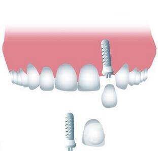 上海九院做一次種植牙價格是多少？價格貴嗎？ 