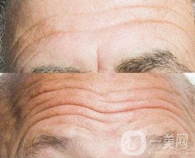 抬頭紋太重怎么辦？怎么消除抬頭紋？