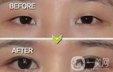 開眼角,多少錢,注意事項(xiàng)