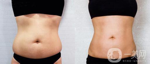 西安抽脂減肥價格 怎樣擁有好身材