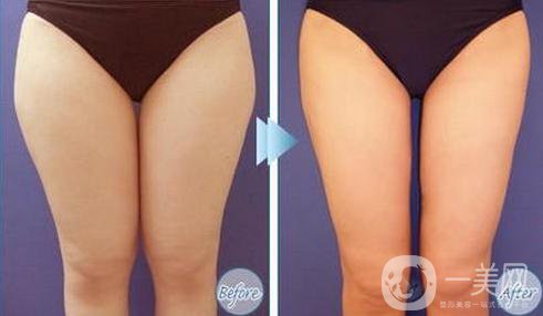 光纖溶脂瘦大腿好不好 適合哪些人做？