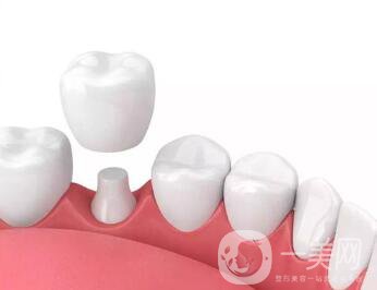 深圳做烤瓷牙一般要多少錢(qián)