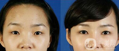 開內(nèi)外眼角多少錢？開眼角價格盤點！