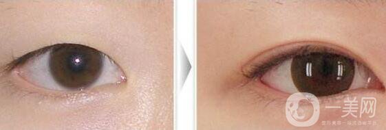 開眼角手術(shù)前后，術(shù)后*果杠杠的！