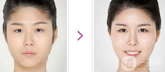 開眼角手術(shù)前后，術(shù)后*果杠杠的！