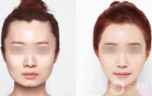 咬肌發(fā)達怎么辦？怎么處理？