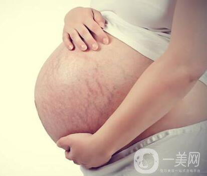 有妊娠紋怎么辦？什么方法**？
