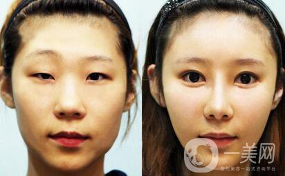 眼部抽脂前后，*果*看過(guò)來(lái)！