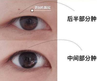 眼部抽脂前后，*果*看過(guò)來(lái)！