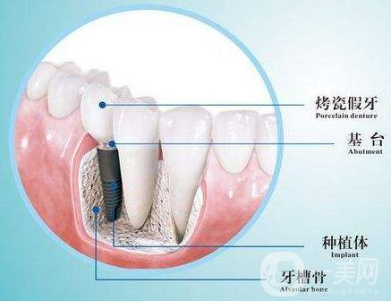 人工種植牙的價(jià)格要多少錢？