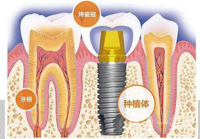 人工種植牙的價(jià)格要多少錢？