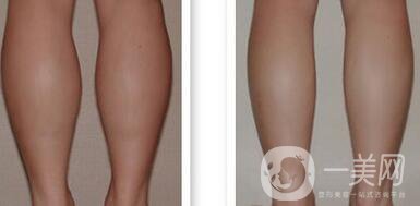 小腿吸脂能瘦幾厘米 輕松擁有纖細雙腿