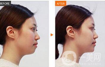 玻尿酸,注射豐耳垂,注意事項