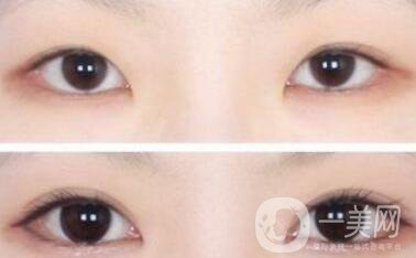 哪些人不適合做雙眼皮手術(shù)