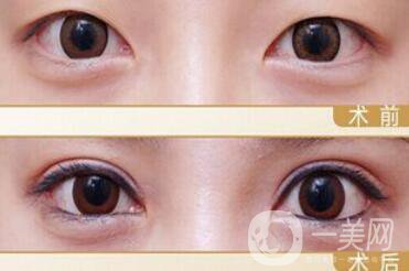 哪些人不適合做雙眼皮手術(shù)