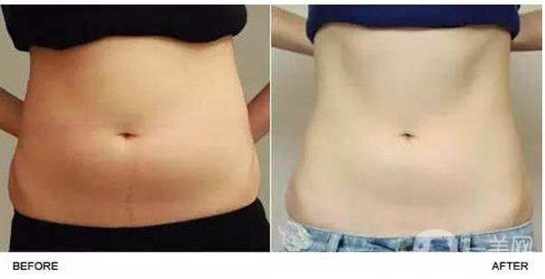 鐳射溶脂,副作用