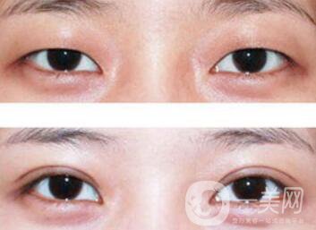 納米*雙眼皮術(shù)后注意事項(xiàng)有哪些