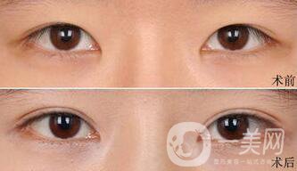 納米*雙眼皮術(shù)后注意事項(xiàng)有哪些