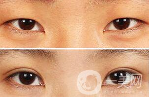 納米*雙眼皮術(shù)后注意事項(xiàng)有哪些