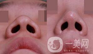 鼻小柱延長(zhǎng)手術(shù)一般都用什么材料