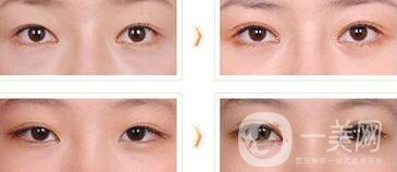 全切雙眼皮術后吃什么？術后如何護理